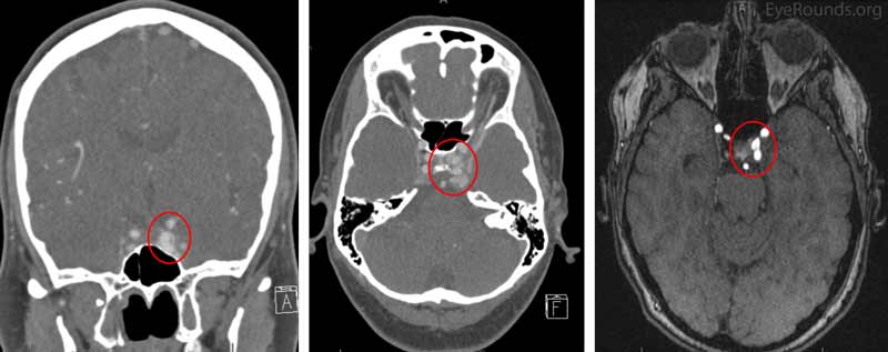 Figure 4. Pre-operative CT imaging (left images) and post-operative MR angiography (right image).There was early filling of the left cavernous sinus on the arterial phase images (circled in red). This represented leakage of contrast from the internal carotid artery to the left cavernous sinus. 