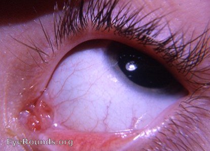 anatomical anomaly of caruncula lacrimalis