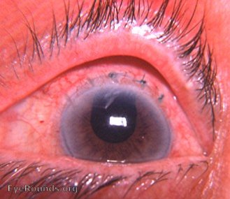 Intracapsular cataract extraction (ICCE) operation in 1977 (Resultant surgical wound repair).