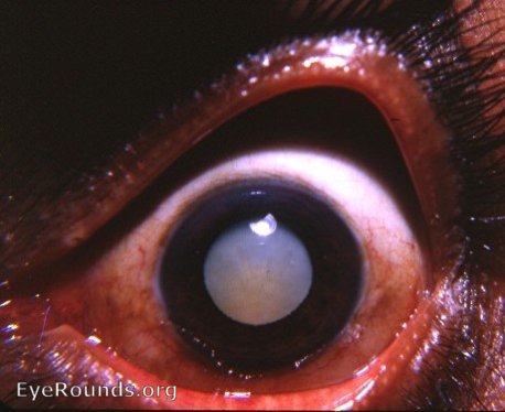 Cataract: bilateral mature senile cataract - typical patient at thEye Clinic in rural India