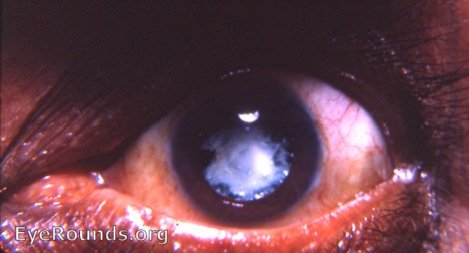 membranous cataract / cataracta membranacea