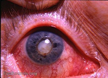 Cataracta complicata with chronic uveitis