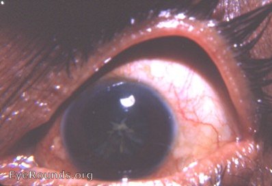 cataracta stellata