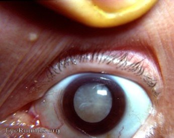 Cataract: bilateral mature senile cataract - typical patient at thEye Clinic in rural India