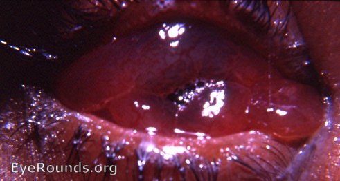 chemosis - marked edema of the bulbar conjunctiva following evisceration