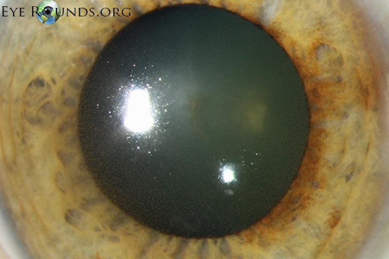 very close up of cornea