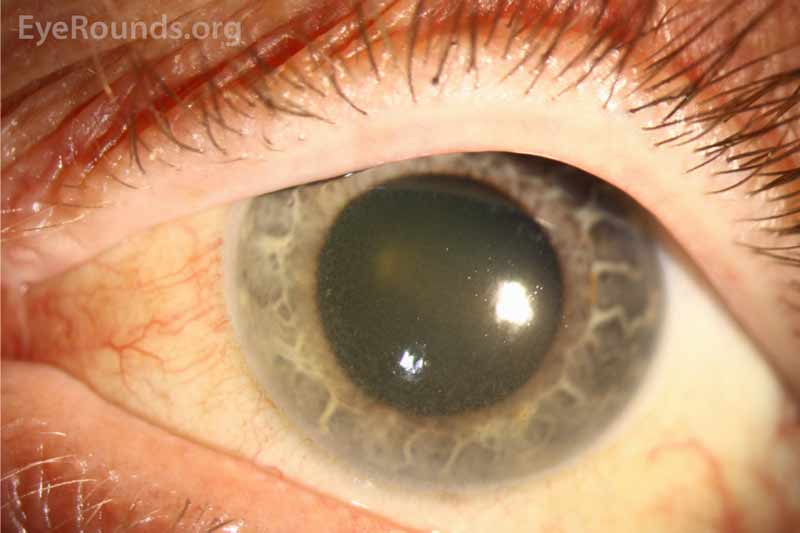 Slit lamp examination shows diffuse punctate corneal deposits through the posterior stroma, descemet membrane, and endothelium of the cornea