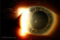 Corneal and lenticular pigmentation from long-term chlorpromazine use