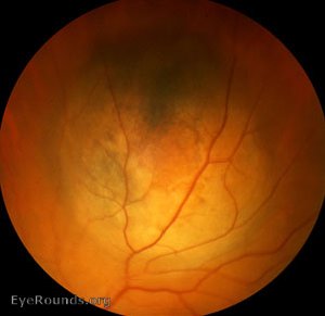 Malignant melanoma of the choroid - mushroom shaped configuration