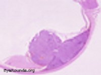 Malignant melanoma of the choroid - mushroom shaped configuration