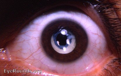 congenital cataract in the membranous cataract stage