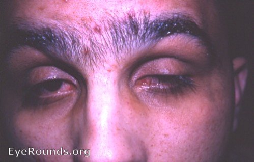 two eyes bilateral ptosis