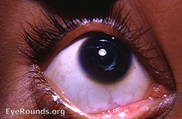 congenital cataract - post-op extracapsular cataract surgery