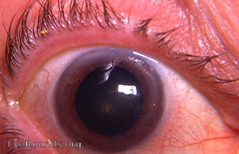 familial bilateral congenital mydriasis