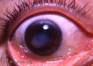 syphilis: congenital interstitial keratitis