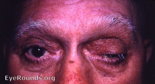 two eyes unilateral ptosis