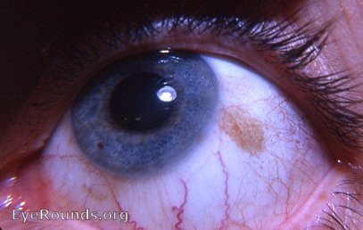 bulbar conjunctival nevus