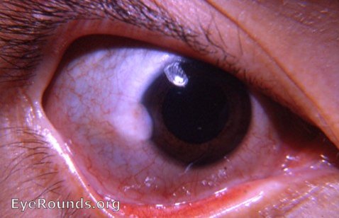 corneoconjunctival ( limbal ) dermoid tumor