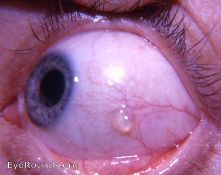 conjunctival cyst: epithelial inclusion cyst