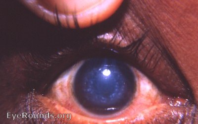 Groenouw I granular corneal dystrophy