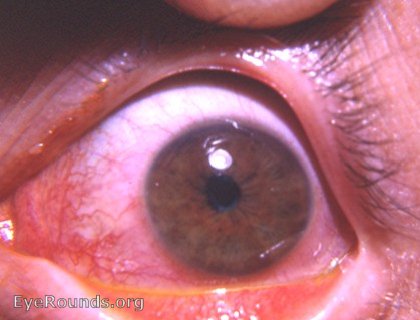 cornea: stained marginal corneal abrasion between superior limbus and light reflex.