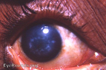 Groenouw I granular corneal dystrophy