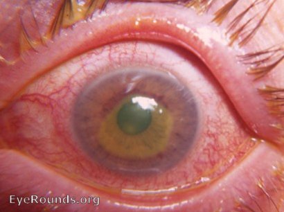 corneal erosion OS