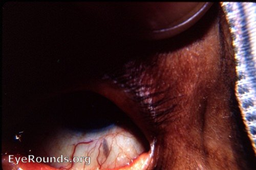 Telltale scleral scar in a couched eye