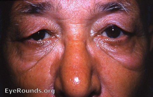 cutis laxa/dermatochalasis palpebrae