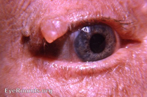 Cyst: cyst of gland of Moll; also, papilloma upper lid