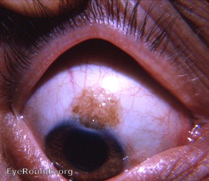 cystic pigmented nevus of the bulbar conjunctiva