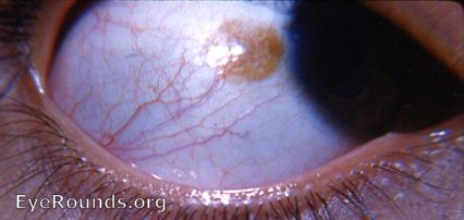 cystic pigmented nevus of the bulbar conjunctiva in the palpebral fissure zone