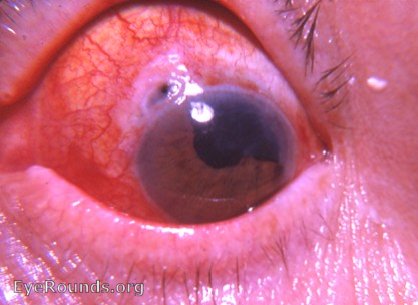 Cataract: cystoid cicatrix and ectropion uveae following intracapsular cataract surgery with a complete iridectomy