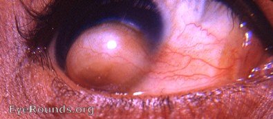 corneoconjunctival ( limbal ) dermoid tumor