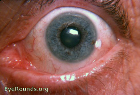 Limbal dyskeratosis