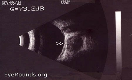 hemangioma ultrasound Cavernous hemangioma 