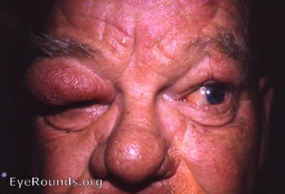 elephantiasis nostras of rt. upper lid