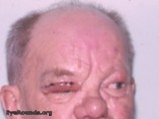 elephantiasis nostras: postop - excision of tissue of upper lid OD