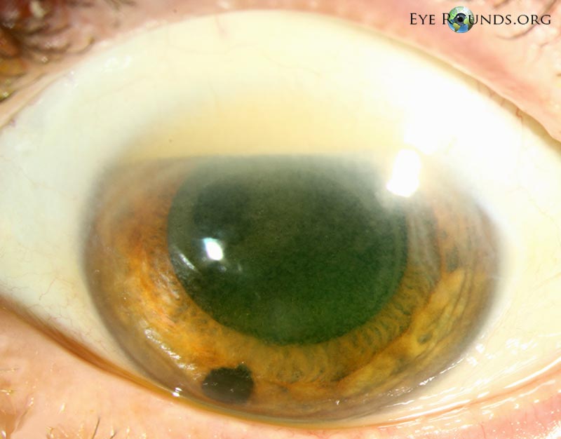 Emulsified silicon oil in Anterior Chamber