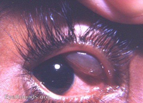 conjunctival cyst: huge