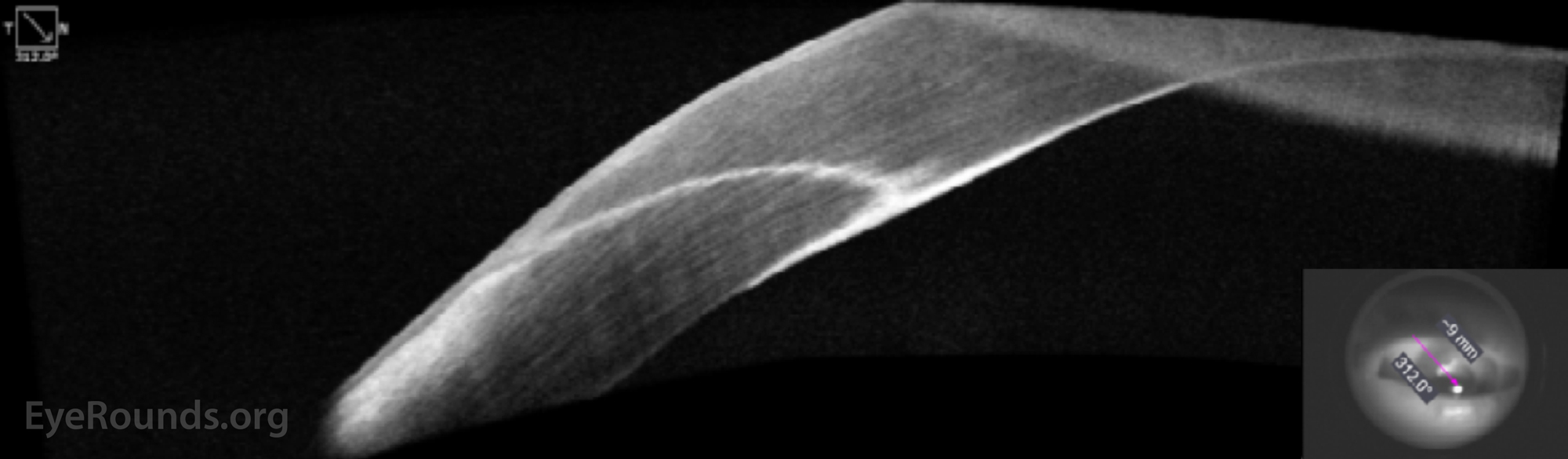 Optical coherence tomography of the anterior segment demonstrating a hyperreflective sheet of presumed epithelial cells