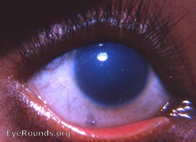 familial corneal dystrophy