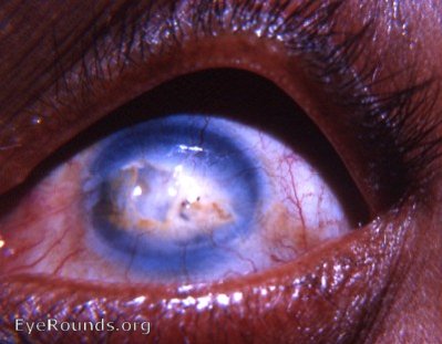 fatty and calcareous degeneration of the cornea