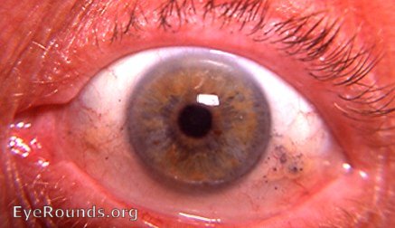 multiple old bulbar conjunctival foreign bodies
