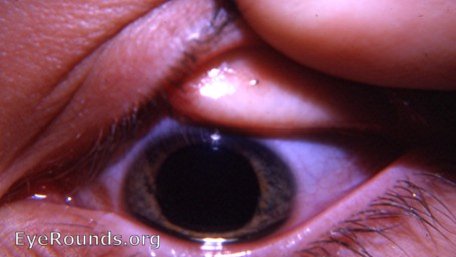 forign body - conjunctiva upper lid