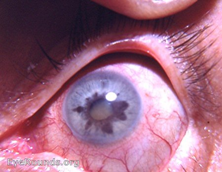 heterochromia iridis caused by chronic cyclitis