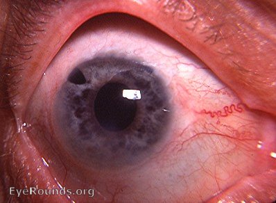 Fuchs' heterochromic cyclitis - post-op aphakia OD