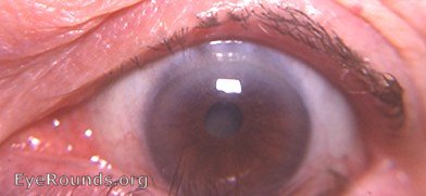 Fuchs' heterochromic cyclitis - post-op aphakia OD