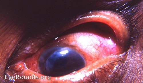 postop cataract complication: massive prolapse of the iris