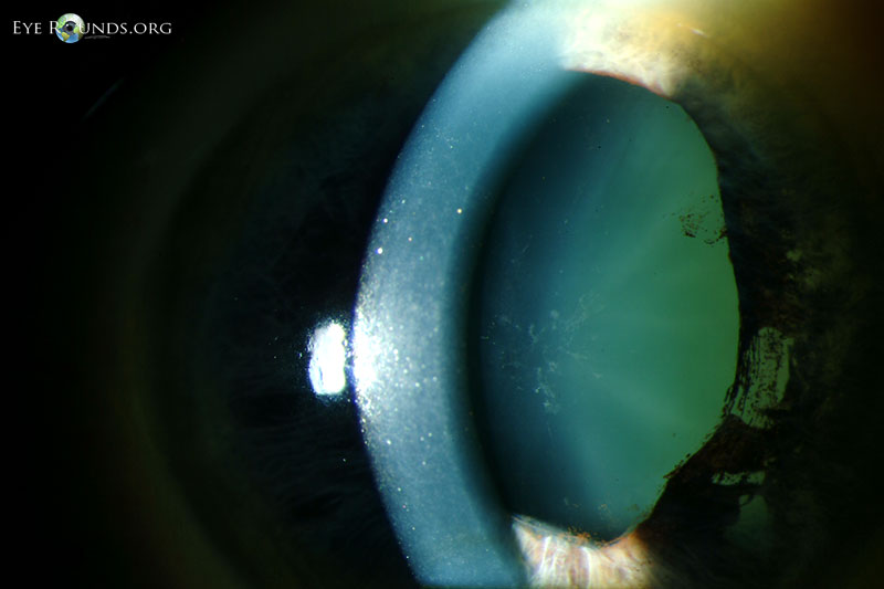 Related Atlas Entry: Oculodermal melanocytosis (nevus of Ota)